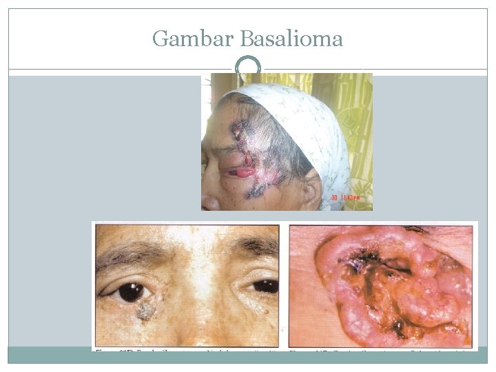 Gambar Basalioma 