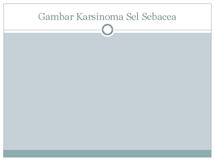 Gambar Karsinoma Sel Sebacea 