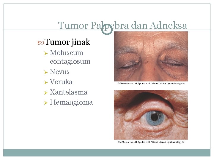 Tumor Palpebra dan Adneksa Tumor jinak Ø Moluscum contagiosum Ø Nevus Ø Veruka Ø