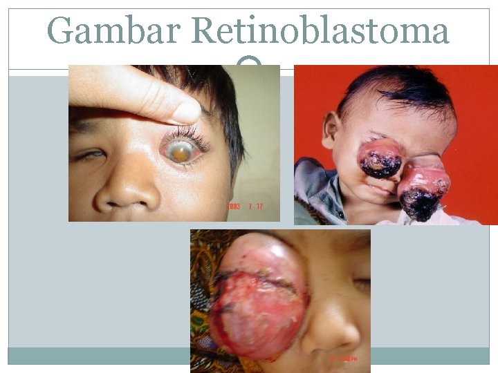 Gambar Retinoblastoma 
