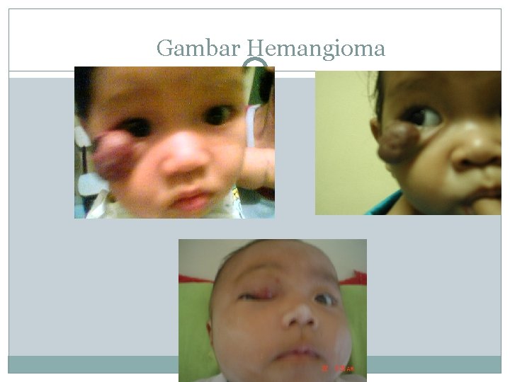 Gambar Hemangioma 