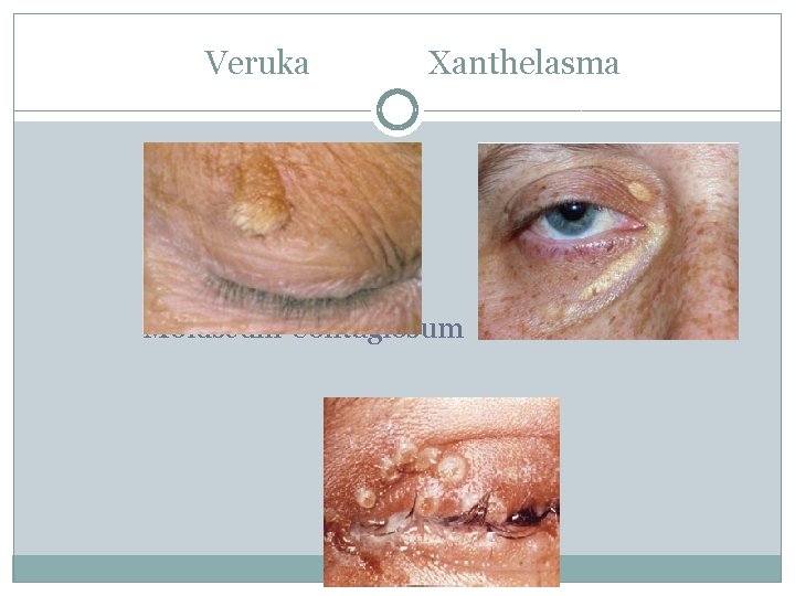 Veruka Xanthelasma Moluscum Contagiosum 