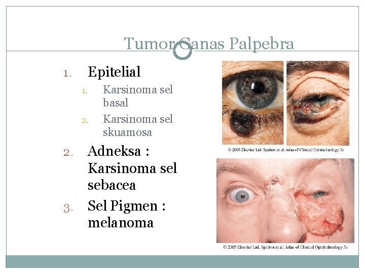 Tumor Ganas Palpebra Epitelial 1. 1. 2. 3. Karsinoma sel basal Karsinoma sel skuamosa