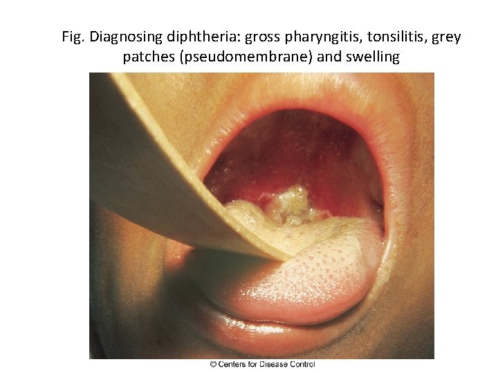 Fig. Diagnosing diphtheria: gross pharyngitis, tonsilitis, grey patches (pseudomembrane) and swelling 