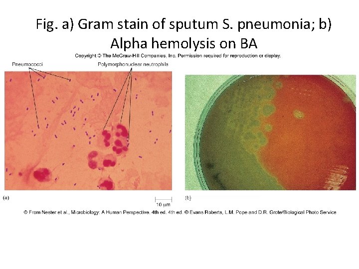 Fig. a) Gram stain of sputum S. pneumonia; b) Alpha hemolysis on BA 