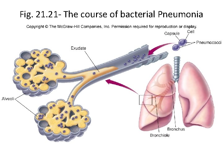 Fig. 21 - The course of bacterial Pneumonia 
