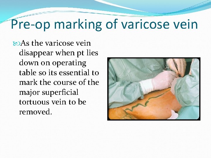 Pre-op marking of varicose vein As the varicose vein disappear when pt lies down