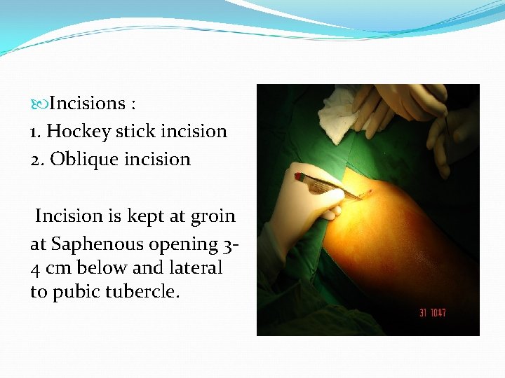 Incisions : 1. Hockey stick incision 2. Oblique incision Incision is kept at