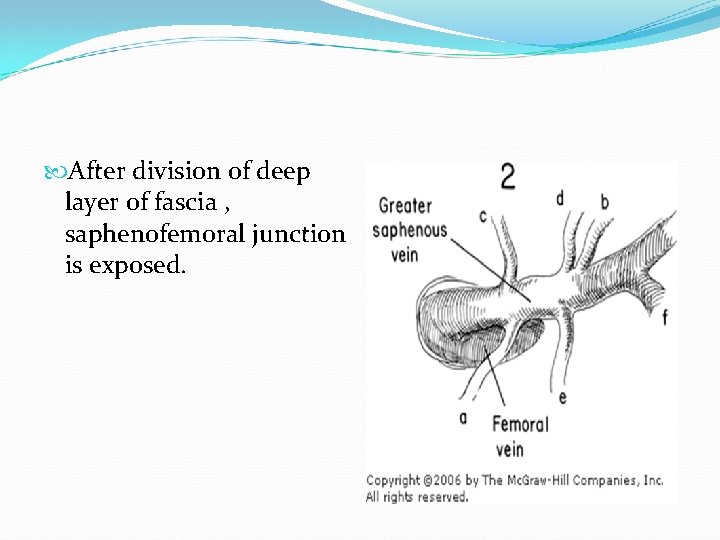  After division of deep layer of fascia , saphenofemoral junction is exposed. 