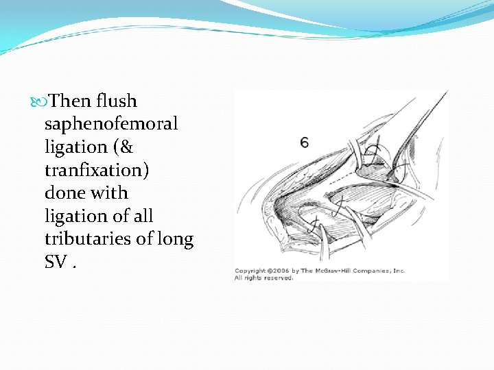  Then flush saphenofemoral ligation (& tranfixation) done with ligation of all tributaries of