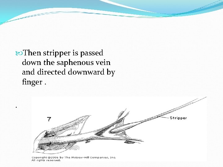  Then stripper is passed down the saphenous vein and directed downward by finger.