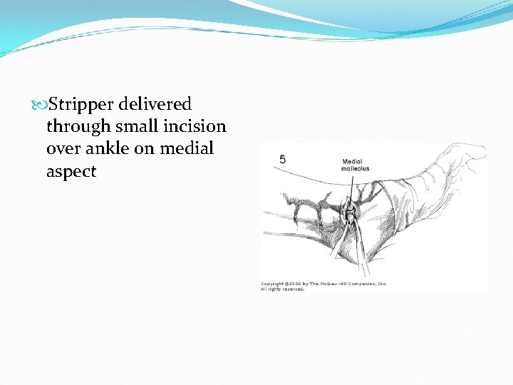  Stripper delivered through small incision over ankle on medial aspect 