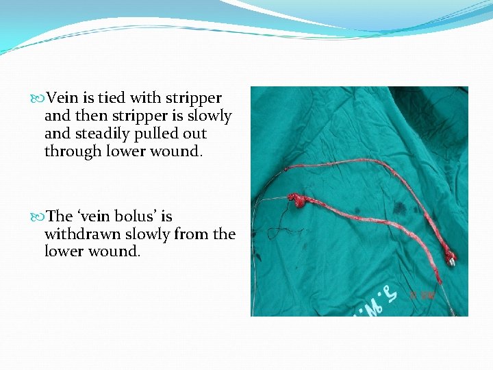  Vein is tied with stripper and then stripper is slowly and steadily pulled