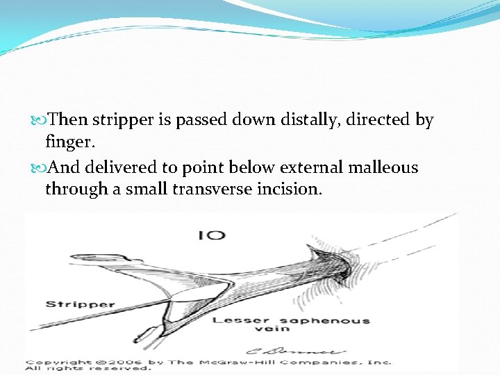  Then stripper is passed down distally, directed by finger. And delivered to point