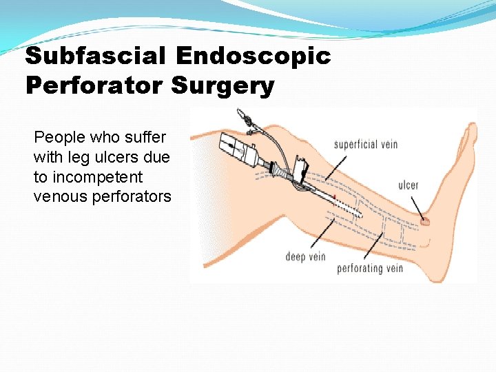 Subfascial Endoscopic Perforator Surgery People who suffer with leg ulcers due to incompetent venous