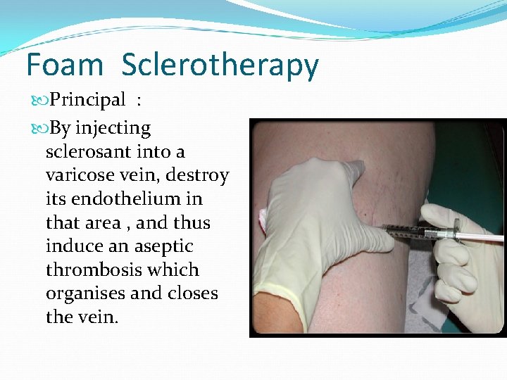 Foam Sclerotherapy Principal : By injecting sclerosant into a varicose vein, destroy its endothelium