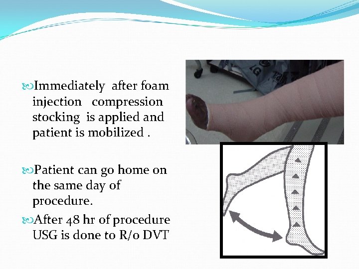  Immediately after foam injection compression stocking is applied and patient is mobilized. Patient