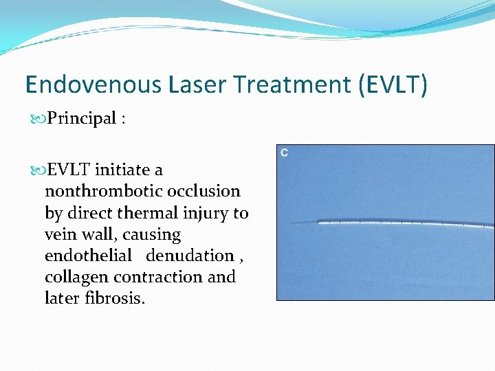 Endovenous Laser Treatment (EVLT) Principal : EVLT initiate a nonthrombotic occlusion by direct thermal