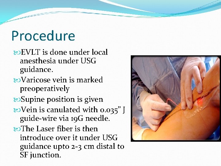 Procedure EVLT is done under local anesthesia under USG guidance. Varicose vein is marked