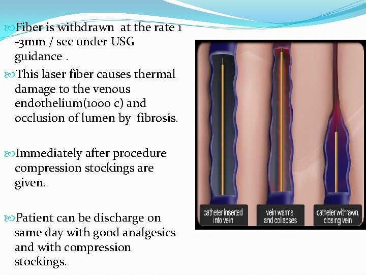  Fiber is withdrawn at the rate 1 -3 mm / sec under USG