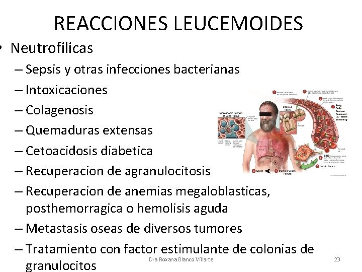 REACCIONES LEUCEMOIDES • Neutrofilicas – Sepsis y otras infecciones bacterianas – Intoxicaciones – Colagenosis