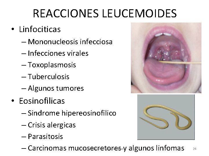 REACCIONES LEUCEMOIDES • Linfociticas – Mononucleosis infecciosa – Infecciones virales – Toxoplasmosis – Tuberculosis