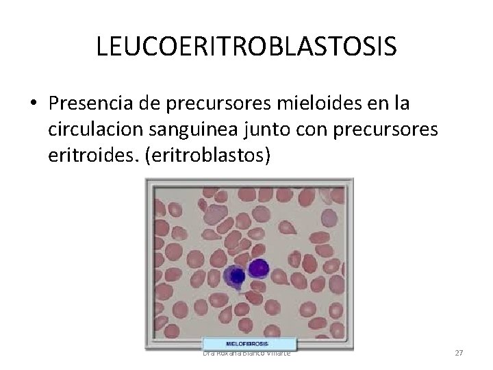 LEUCOERITROBLASTOSIS • Presencia de precursores mieloides en la circulacion sanguinea junto con precursores eritroides.