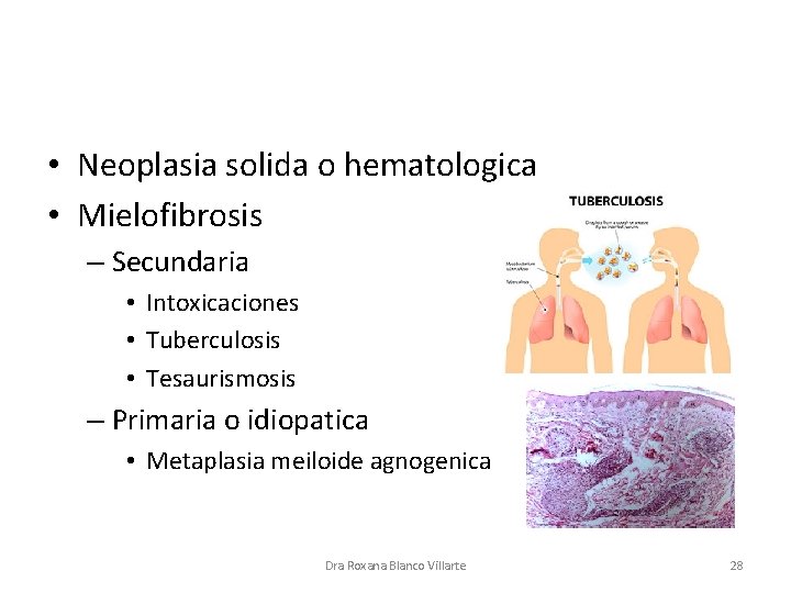  • Neoplasia solida o hematologica • Mielofibrosis – Secundaria • Intoxicaciones • Tuberculosis
