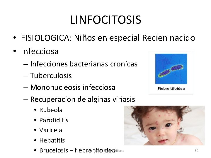LINFOCITOSIS • FISIOLOGICA: Niños en especial Recien nacido • Infecciosa – Infecciones bacterianas cronicas