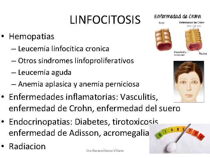 LINFOCITOSIS • Hemopatias – Leucemia linfocitica cronica – Otros sindromes linfoproliferativos – Leucemia aguda