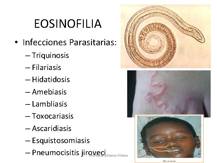 EOSINOFILIA • Infecciones Parasitarias: – Triquinosis – Filariasis – Hidatidosis – Amebiasis – Lambliasis