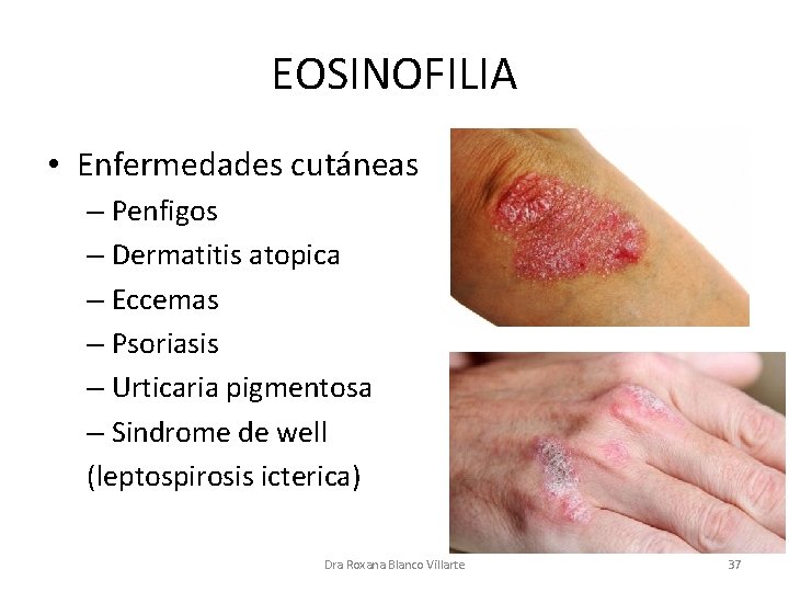 EOSINOFILIA • Enfermedades cutáneas – Penfigos – Dermatitis atopica – Eccemas – Psoriasis –