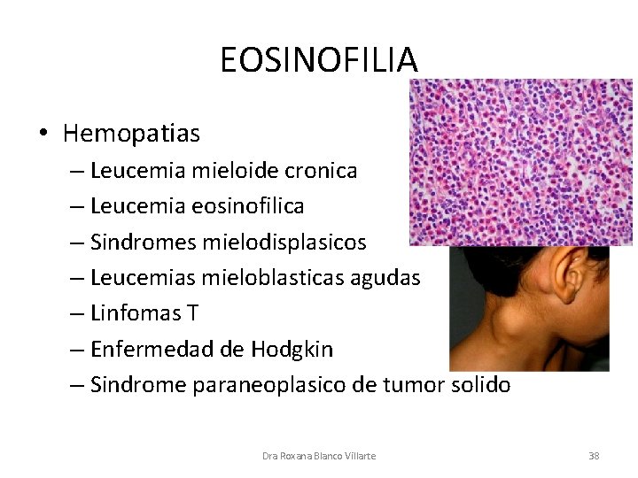EOSINOFILIA • Hemopatias – Leucemia mieloide cronica – Leucemia eosinofilica – Sindromes mielodisplasicos –