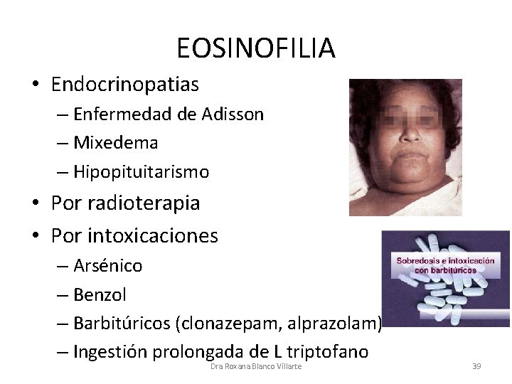 EOSINOFILIA • Endocrinopatias – Enfermedad de Adisson – Mixedema – Hipopituitarismo • Por radioterapia