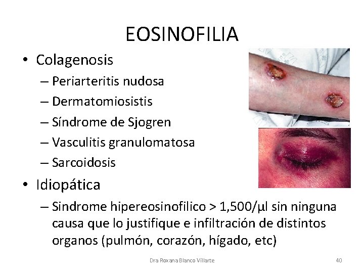 EOSINOFILIA • Colagenosis – Periarteritis nudosa – Dermatomiosistis – Síndrome de Sjogren – Vasculitis