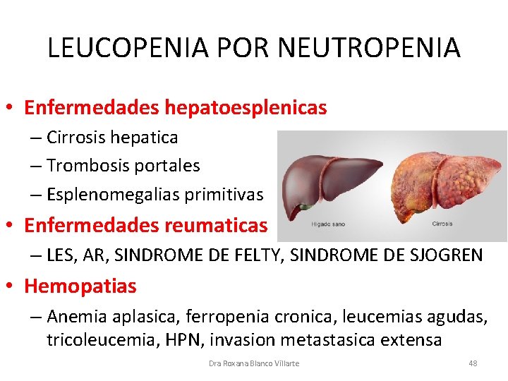 LEUCOPENIA POR NEUTROPENIA • Enfermedades hepatoesplenicas – Cirrosis hepatica – Trombosis portales – Esplenomegalias