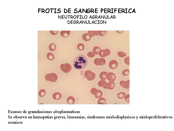 FROTIS DE SANGRE PERIFERICA NEUTROFILO AGRANULAR DEGRANULACION Escasez de granulaciones citoplasmaticas Se observa en