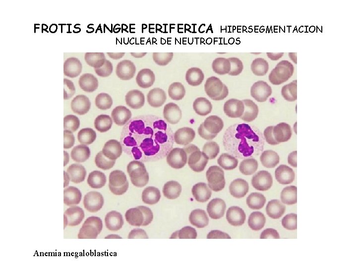 FROTIS SANGRE PERIFERICA HIPERSEGMENTACION NUCLEAR DE NEUTROFILOS Anemia megaloblastica 
