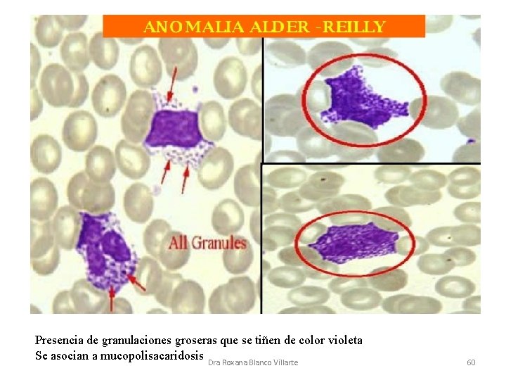 Presencia de granulaciones groseras que se tiñen de color violeta Se asocian a mucopolisacaridosis
