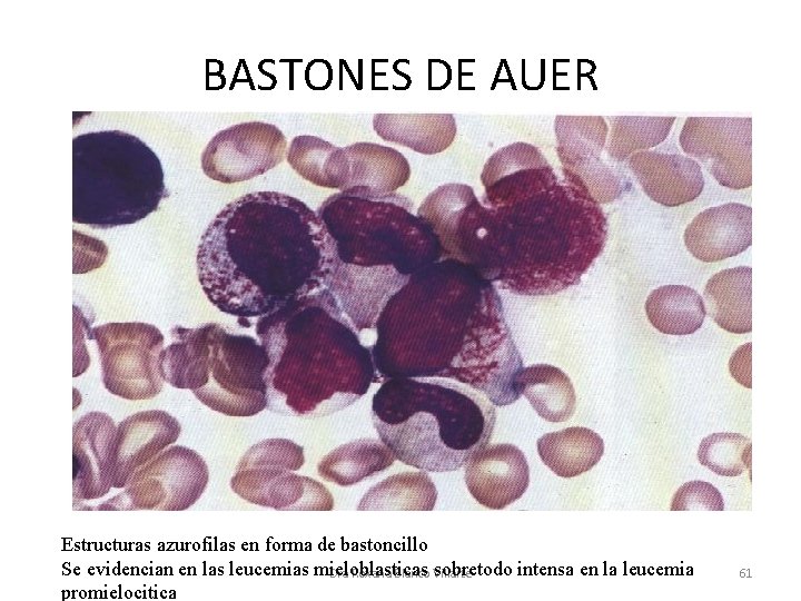 BASTONES DE AUER Estructuras azurofilas en forma de bastoncillo Se evidencian en las leucemias