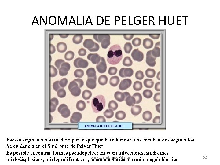 ANOMALIA DE PELGER HUET Escasa segmentación nuclear por lo queda reducida a una banda