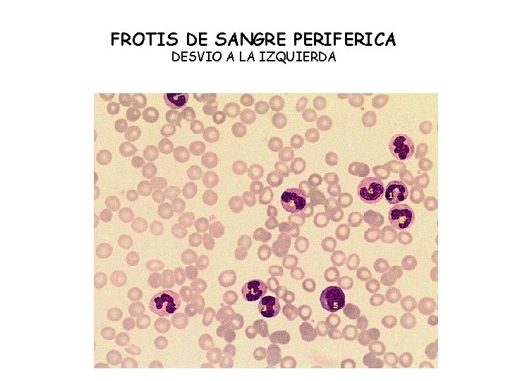 FROTIS DE SANGRE PERIFERICA DESVIO A LA IZQUIERDA 