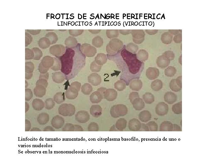 FROTIS DE SANGRE PERIFERICA LINFOCITOS ATIPICOS (VIROCITO) Linfocito de tamaño aumentado, con citoplasma basofilo,