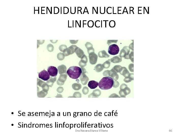 HENDIDURA NUCLEAR EN LINFOCITO • Se asemeja a un grano de café • Sindromes