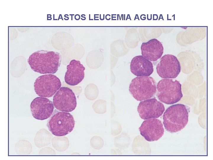 BLASTOS LEUCEMIA AGUDA L 1 