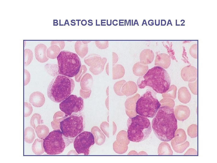 BLASTOS LEUCEMIA AGUDA L 2 