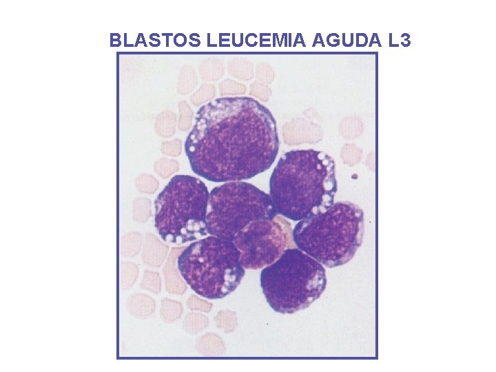 BLASTOS LEUCEMIA AGUDA L 3 