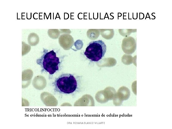 LEUCEMIA DE CELULAS PELUDAS TRICOLINFOCITO Se evidencia en la tricoleucemia o leucemia de celulas