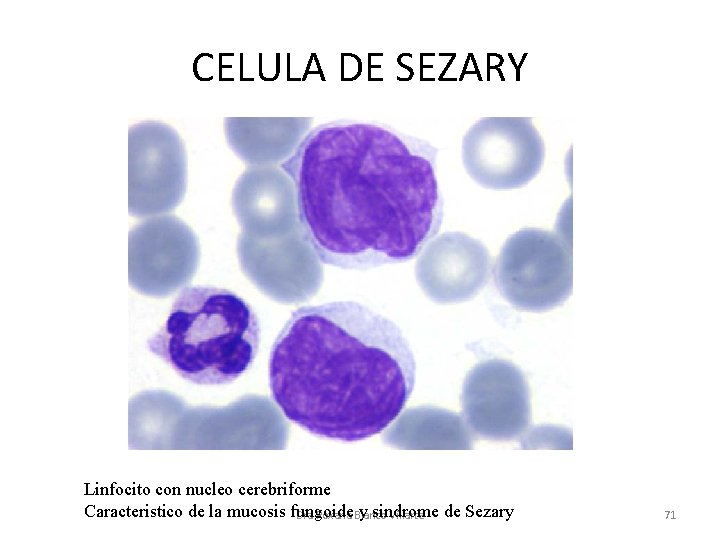 CELULA DE SEZARY Linfocito con nucleo cerebriforme Caracteristico de la mucosis fungoide y sindrome
