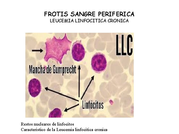 FROTIS SANGRE PERIFERICA LEUCEMIA LINFOCITICA CRONICA Restos nucleares de linfocitos Caracteristico de la Leucemia